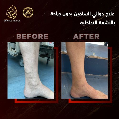 علاج دوالي الساقين